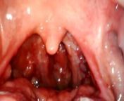 My throat with endoscope from moon khan